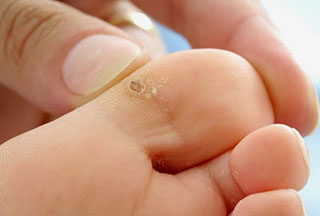 Ինչպես 5 օրվա ընթացքում ազատվել գորտնուկներից