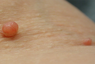 Բնական 8 միջոց՝ մաշկի ավելորդ մսագնդերի դեմ