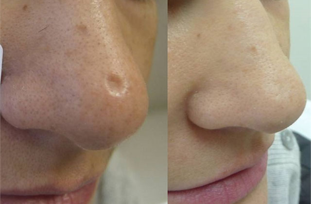 Ազատվեք դեմքի սպիներից բնական բաղադրիչների միջոցով