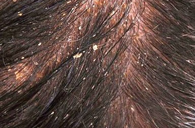 Բնական միջոց՝ թեփի դեմ