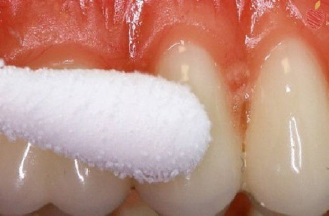 Ազատվեք ատամնացավից հաշված վայրկյանների ընթացքում