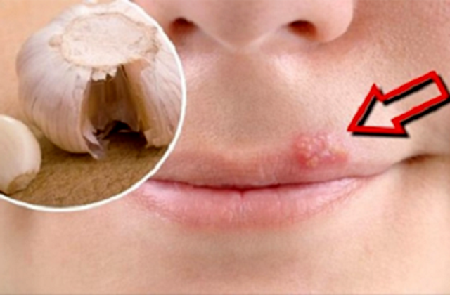 Տնային միջոցներ՝ շուրթերին հերպեսը բուժելու համար