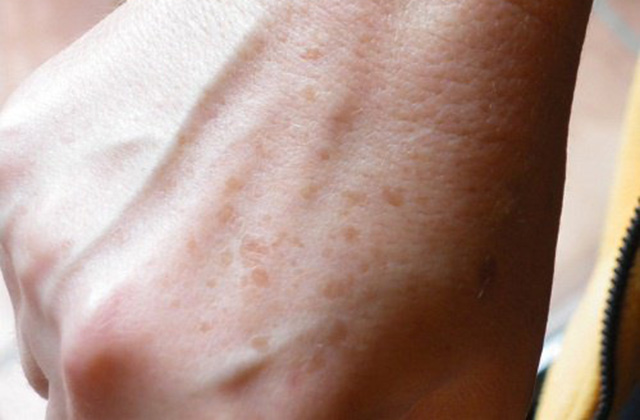 Արդյունավետ բաղադրատոմսեր՝ ձեռքերի պիգմենտային հետքերը վերացնելու համար