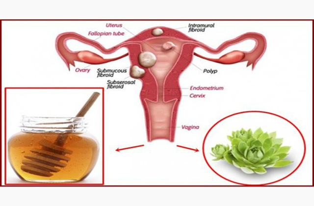 Երկու հրաշալի բաղադրիչներ, որոնք պայքարում են կիստաների և ֆիբրոիդների դեմ
