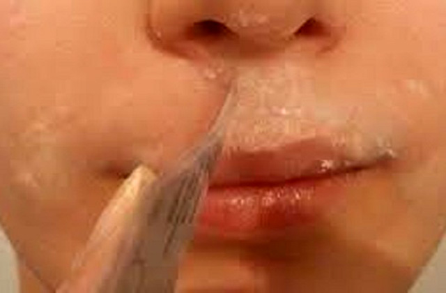 Ազատվեք դեմքի անցանկալի մազերից