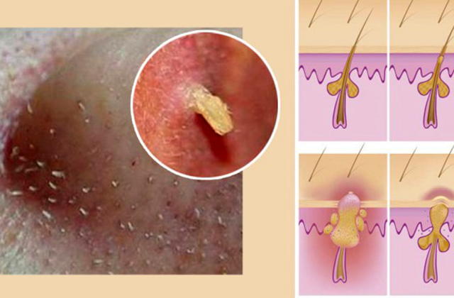 Դիմակ՝ սև կետերի դեմ պայքարելու համար